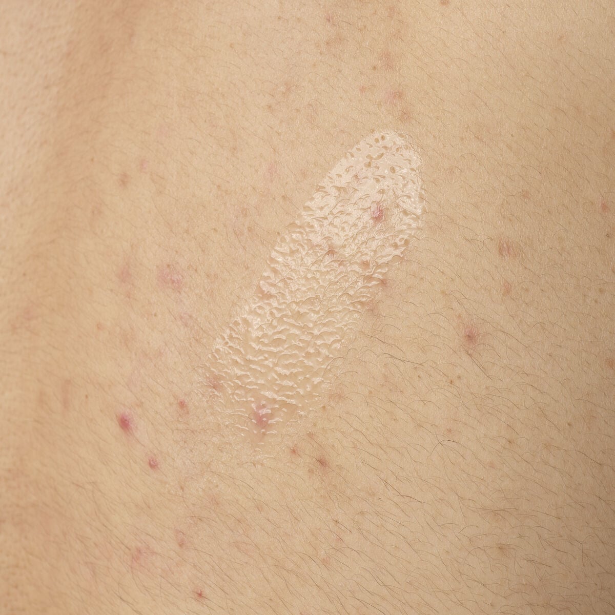 salicylic-acid-0-5-body-serum-c7 ORD-salicylic-acid-05-body-240ml-application.jpg
