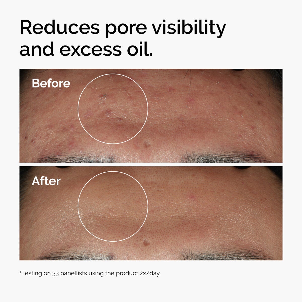 niacinamide-10-zinc-1-f5 ord-niacinamide-zinc-blemish-serum-before-after-pores.jpg