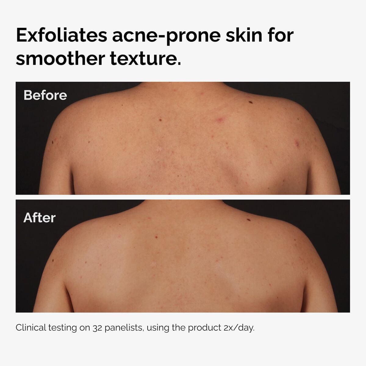 salicylic-acid-0-5-body-serum-c7 ord-salicylic-acid-body-serum-before-after-graphic-NA.jpg