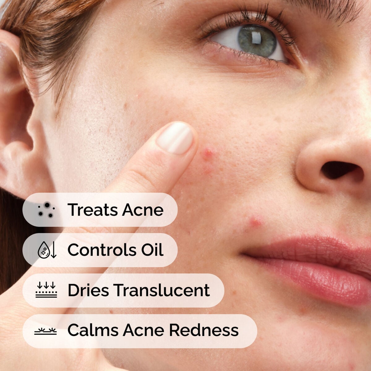 sulfur-10-powder-to-cream-concentrate-m5 ord-sulfur-10pct-powder-to-cream-concentrate-model-application-with-benefits-acne.jpg