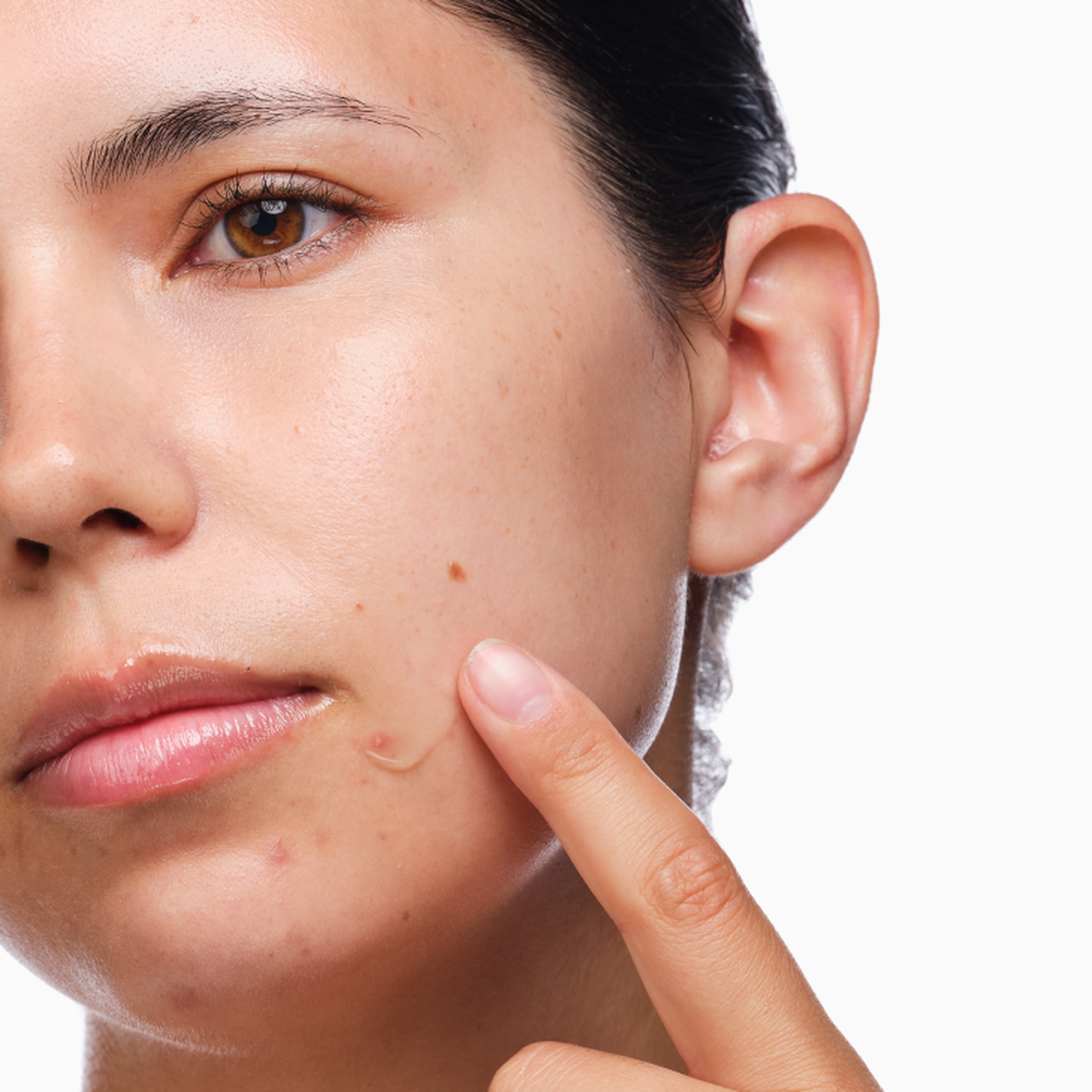 the-acne-set-l7 rdn-the-acne-set-application.png